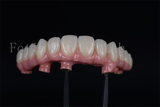 Całkowite przywrócenie naturalnej zdolności żucia za pomocą 4 lub 6 implantów