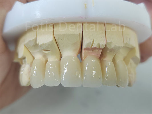 Produkt stomatologiczny Zirkonia z warstwą porcelany Łatwe w utrzymaniu