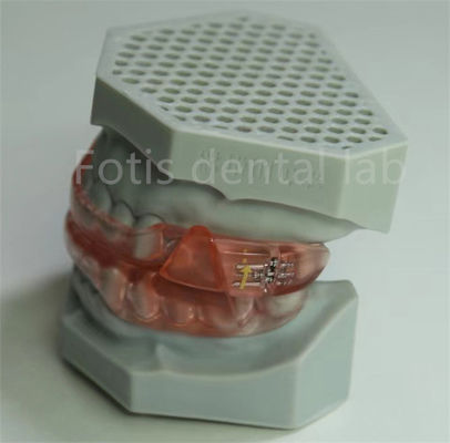 Przystępne ceny Hyrax Expander Orthodontic Retainer Łatwe w czyszczeniu i konserwacji