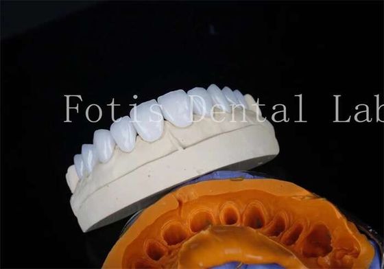 kupować Porcelanowe foliary stomatologiczne z cementem do długotrwałej restauracji online manufacture