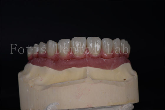 Naturalna estetyka z niedrogimi implantami All on 4 All on 6