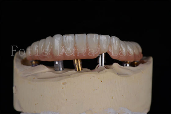 Przystępna cena Naturalny wygląd 4 lub 6 implantów pełny łuk Poziom sukcesu minimalnie inwazyjne rozwiązanie