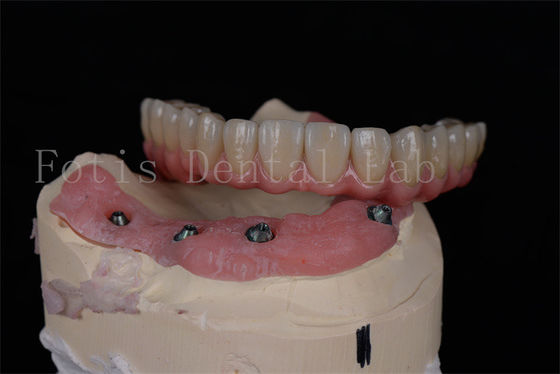 Dostosowalne wszelkie na 4 wszelkie na 6 implanty dentystyczne do pełnej rehabilitacji jamy ustnej