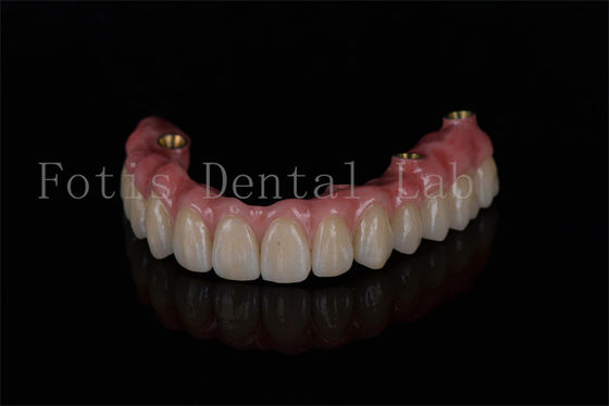 Całkowite odbudowywanie łuku na czterech implantów dla optymalnej wydajności implantów dentystycznych
