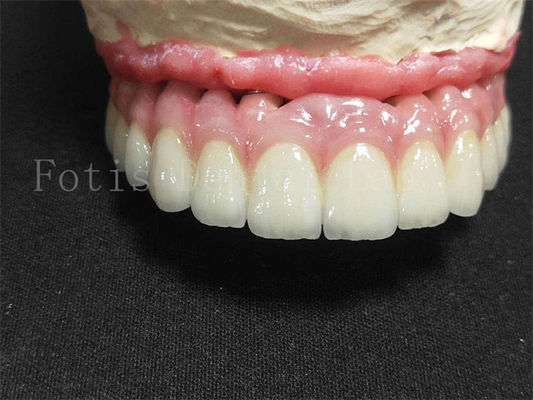 Tytanium / Zirkonia Implant Korona Polerowana Finish Sztuczna Korona Zębowa