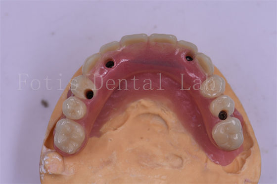 Implant stomatologiczny Titanium Korona zęba Precision Fit Custom Design