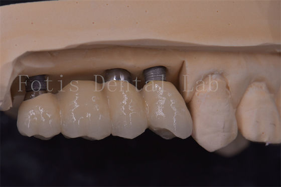 Precyzyjne korony z implantami zębów Titanium / Zirkonia / PFM Odnawianie brakujących zębów