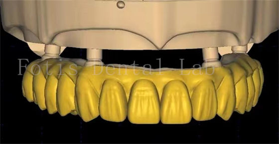 OEM design korony stomatologicznej wykorzystuje zaawansowane technologie skanowania i druku 3D