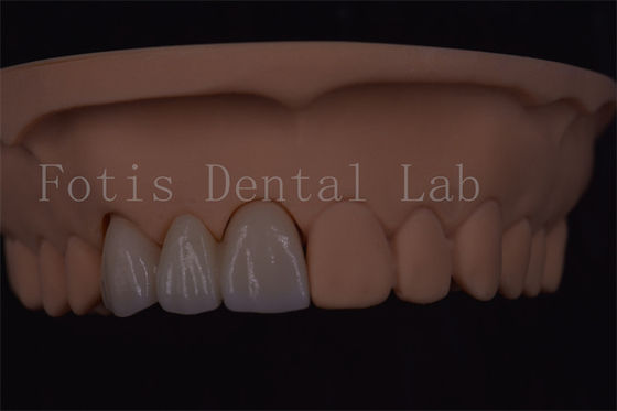 Certyfikowane przez ISO cyfrowe korony dentystyczne do implantów zębów różnych rozmiarów