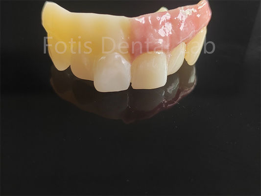 Monolityczny cyrkon z porcelaną