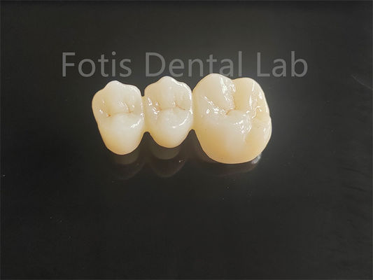 Wysokiej wytrzymałości porcelanowy zirkonia z warstwą dla długotrwałych mostów dentystycznych