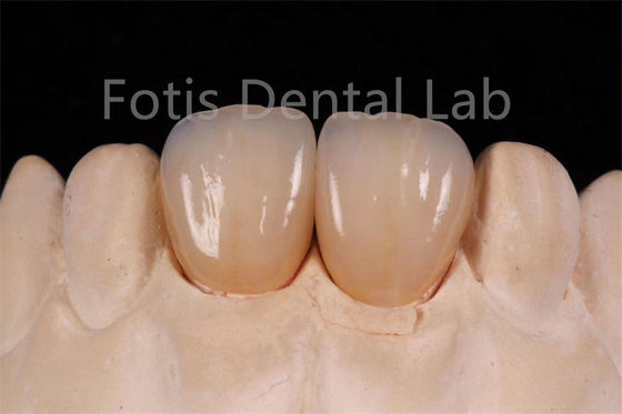 Wysokiej przejrzystości wielowarstwowy cyrkonium do wytwarzania odnośników dentystycznych