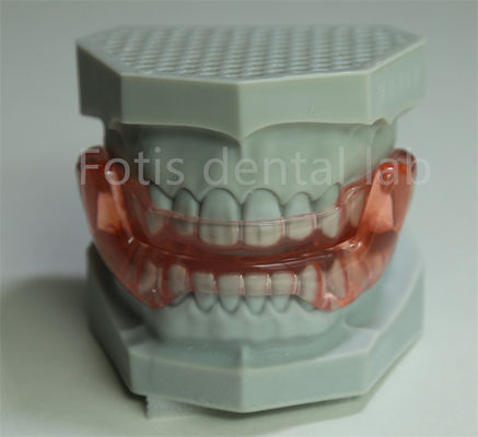 OEM Orthodontic Retainer Expander Wszystkie rozmiary Kompatybilne z większością zabiegów ortodontycznych