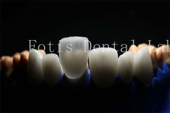 Długotrwałe i trwałe protezy laminowane z materiału porcelanowego